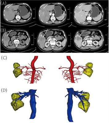 Case report: mixed large-cell neuroendocrine and hepatocellular carcinoma of the liver